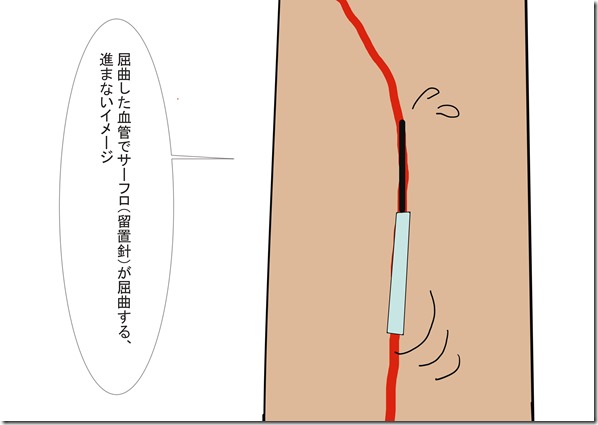 屈曲した血管でサーフロ（留置針）が屈曲する、進まないイメージ