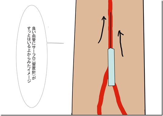 良い血管にサーフロ（留置針）がすっとはいる上からみたイメージ