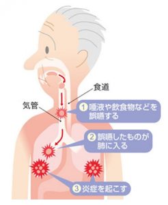 誤嚥性肺炎の図