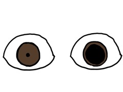 瞳孔不同（アニソコリア）のイメージ図