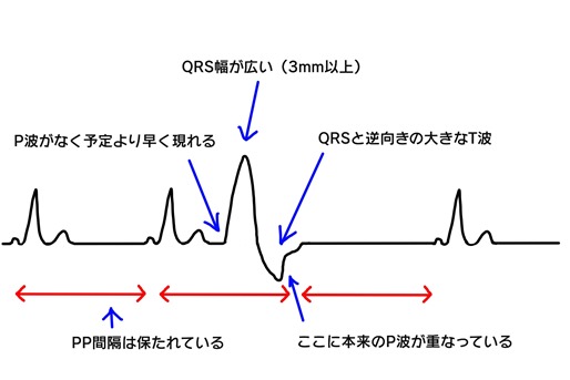 心室期外収縮 PVC波形の特徴