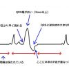 心室期外収縮（PVC）の心電図波形～特徴と重症度がわかる～