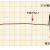 心電図のT波増高が示す、高カリウム血症によるテント状T波とは